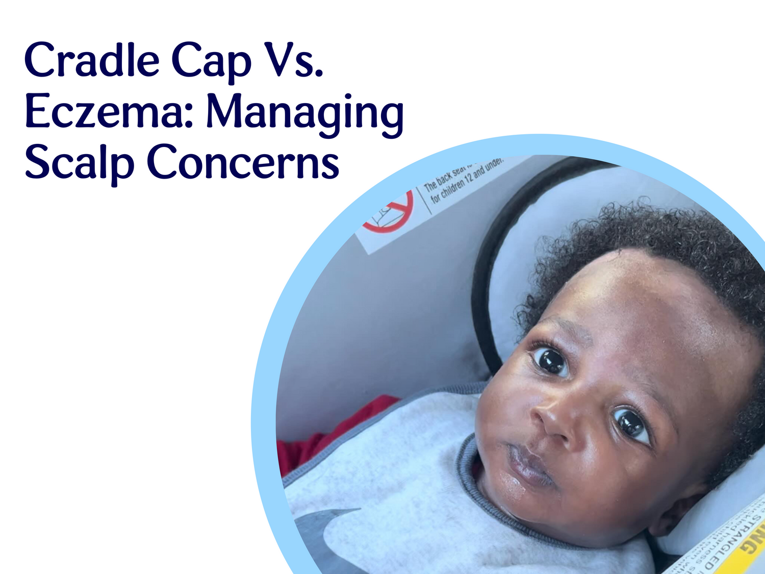 Cradle Cap Vs. Eczema Managing Scalp Concerns Reagan Sanai Natural